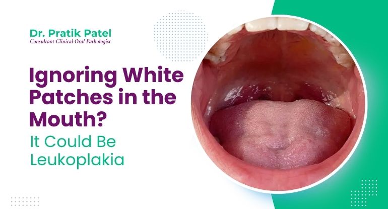 Ignoring White Patches in the Mouth? It Could Be Leukoplakia