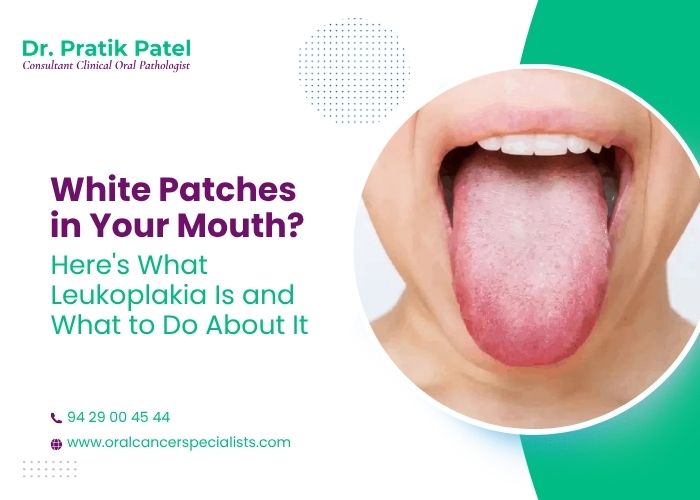 White Patches in Your Mouth? Here's What Leukoplakia Is and What to Do About It
